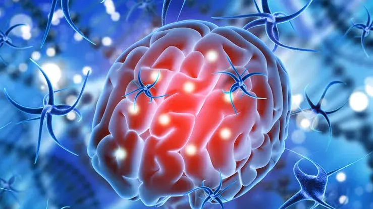 Ilustración de un glioma en el cerebro humano