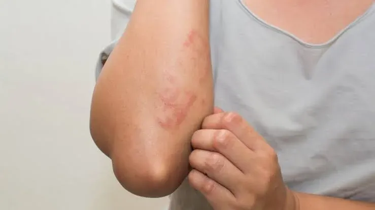 Persona con dermatitis atópica mostrando lesiones cutáneas en las manos